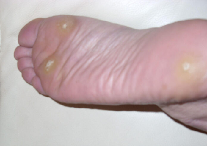 Understanding and Treating Warts on a Dog: A Comprehensive Guide
